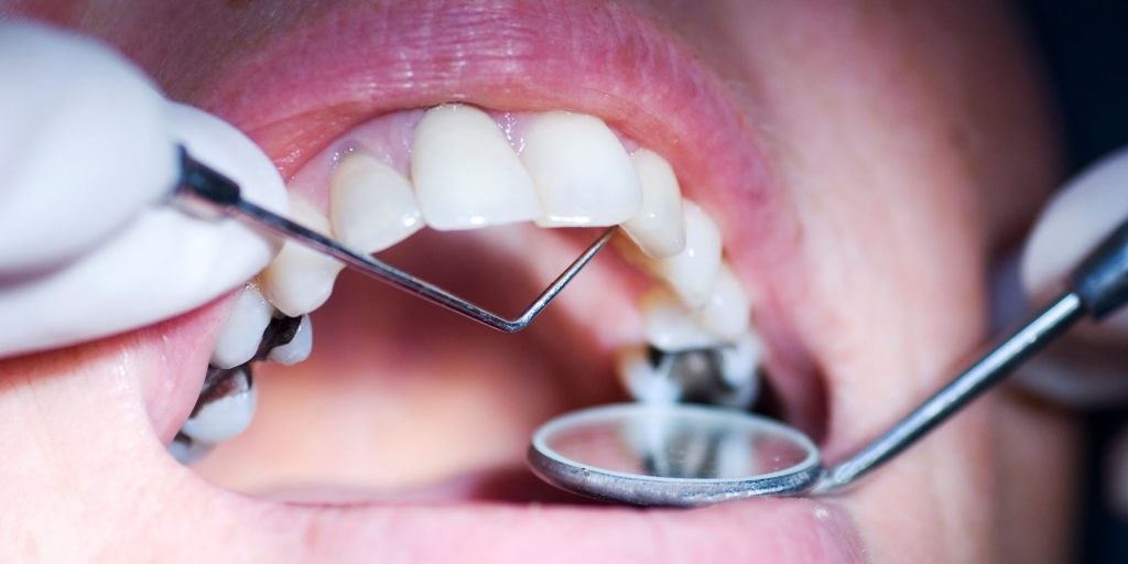 Tooth Cavity-Treatment